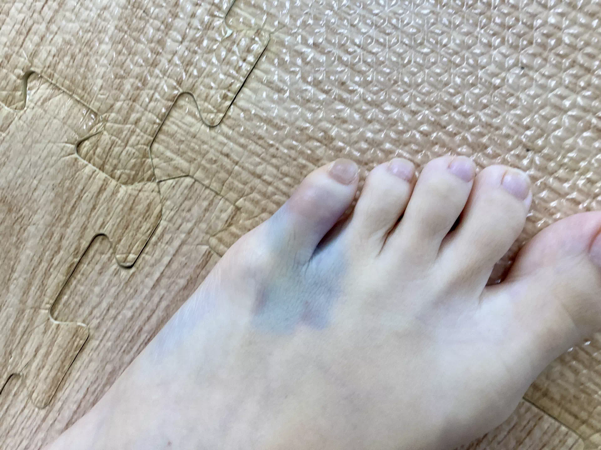 足の小指の付け根が腫れている指